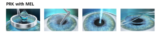 The Different Types of Refractive Surgery Atlas Eye