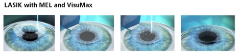 The Different Types of Refractive Surgery - Atlas Eye