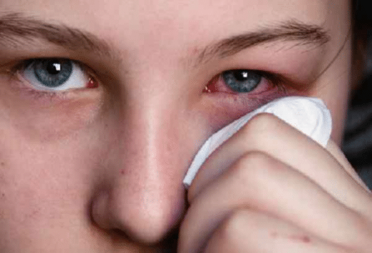 eye infection