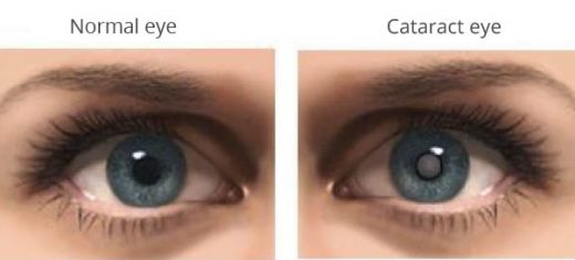 cerulean cataract