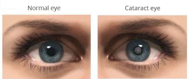 cataract eye conditions