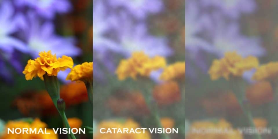 Cataract vision