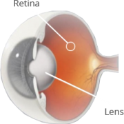 cataract surgery in Singapore