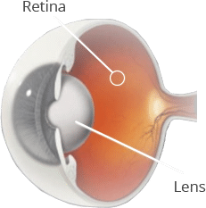 cataract surgery in Singapore