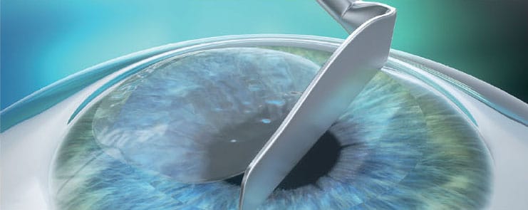 laser eye surgery singapore