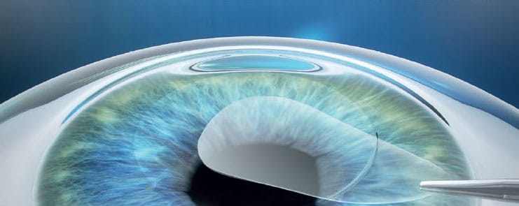 laser eye surgery singapore