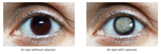 ELIMINATE CATARACTS WITHOUT SURGERY