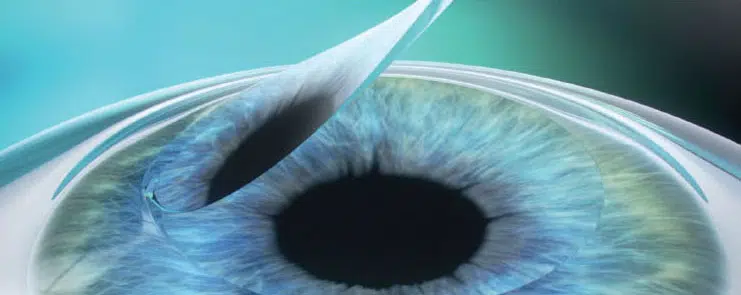 LASIK 准分子激光原位角膜磨镶术