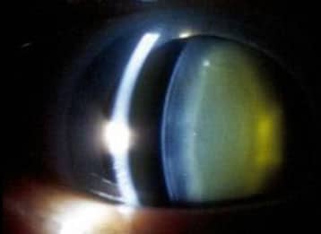 cataract type 1