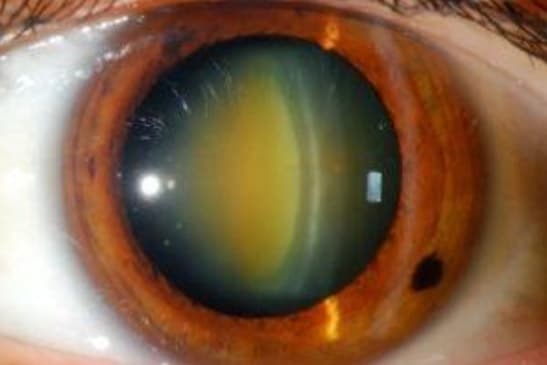 Nuclear sclerotic cataract Atlas Eye