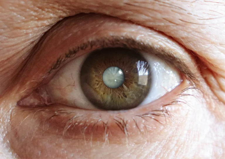 After Cataract