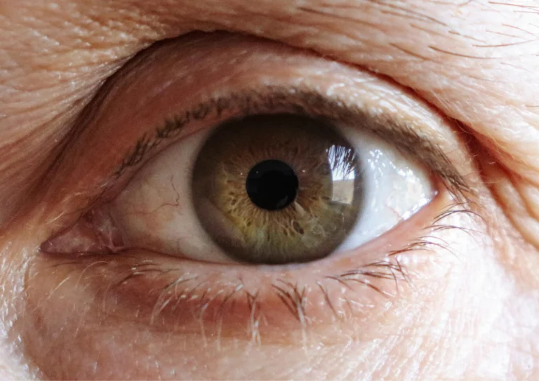 Before Cataract