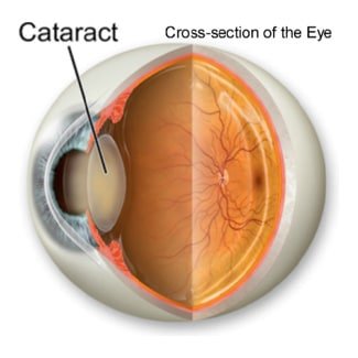cataract-article