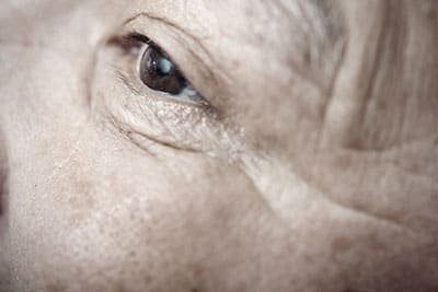 cataract eye