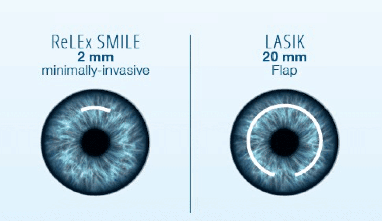 compare relex smile lasik