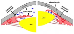 glaucoma