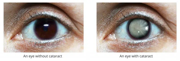 Normal eye vs cataract eye comparison