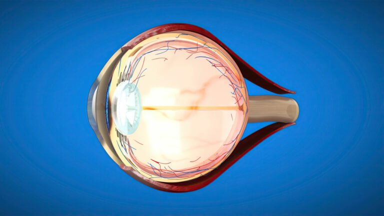 stages of cataract