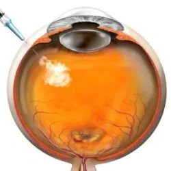 Injection