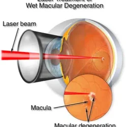 Laser Treatment laser treatment